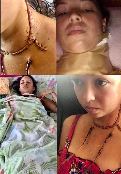 Joven cancer tiroides