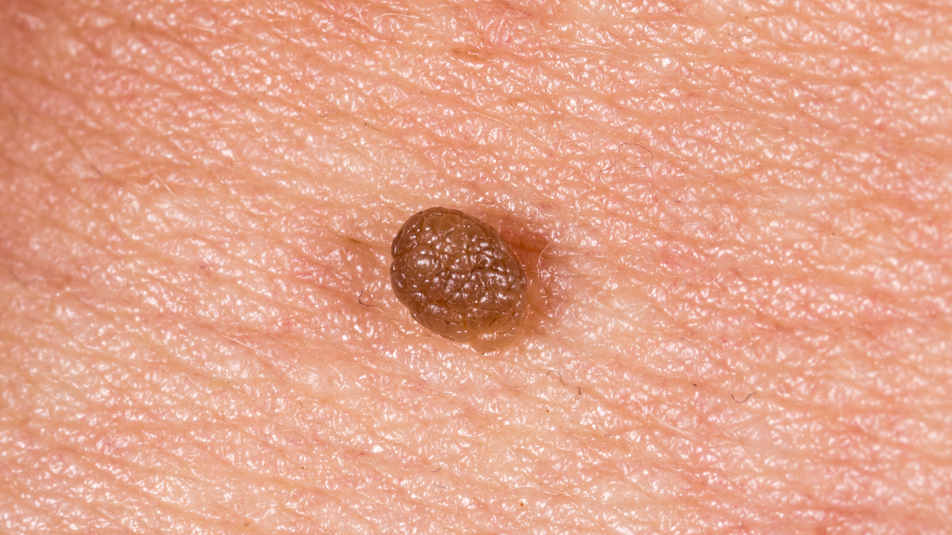 Así puede lucir una lesión provocada por el Virus del Papiloma Humano