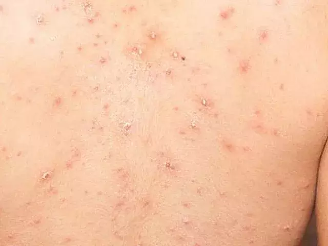 Viruela del mono | Luis Cárdenas