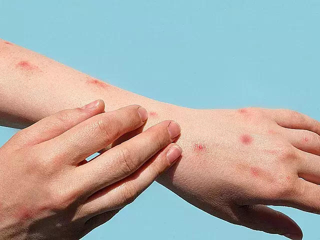 Monkeypox | Marina Demidiuk