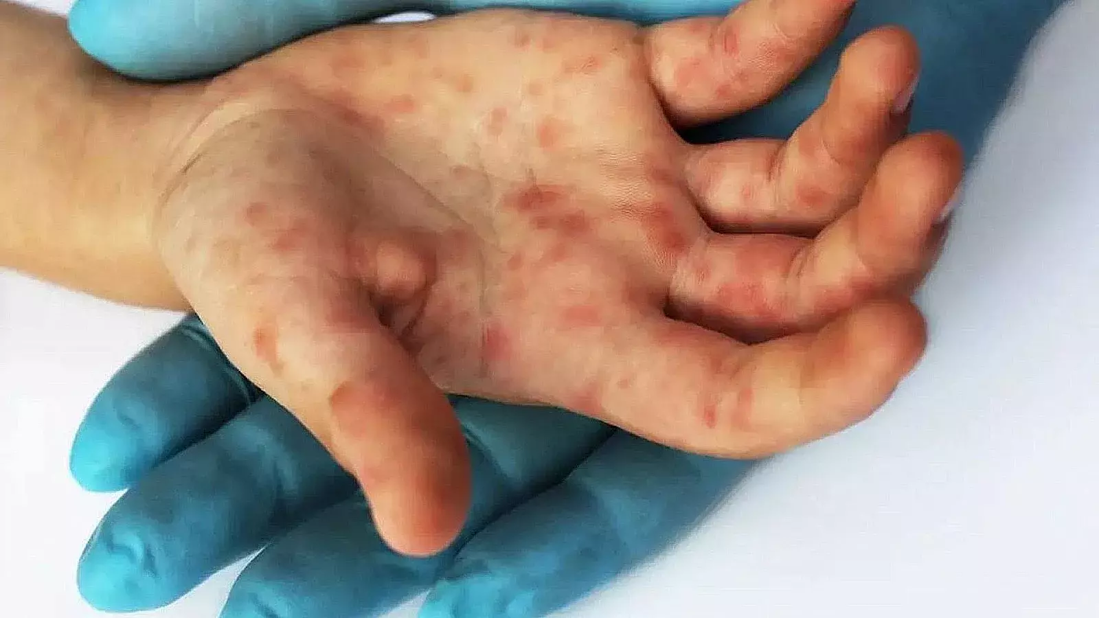 Lesiones en la piel causadas por la viruela del mono
