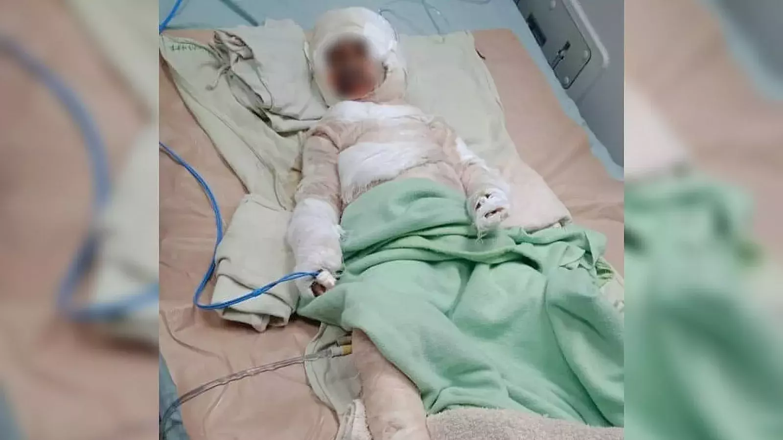 Niño quemado en la provincia de Pinar del Río