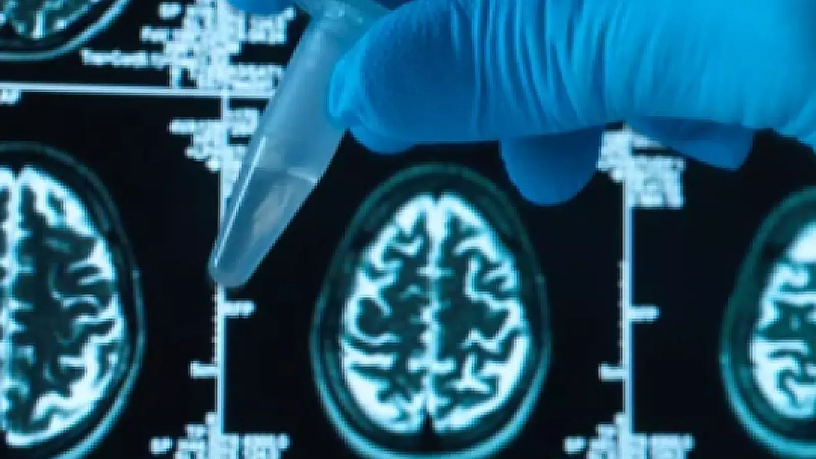 La Inteligencia Artificial ya puede predecir si padecerás Alzheimer