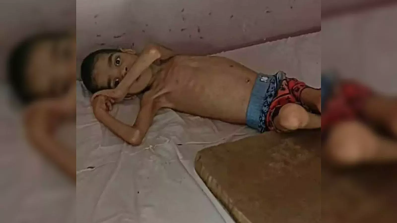 Niño cubano con desnutrición severa