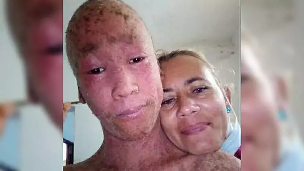 Adolescente cubano de 15 años con rara enfermedad