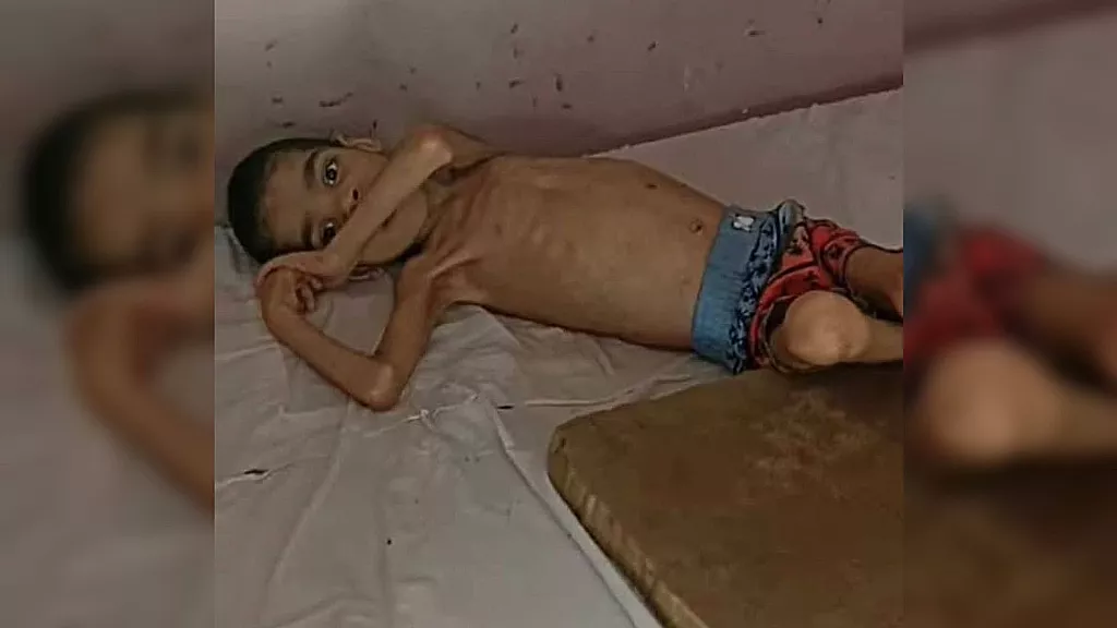 Niño cubano con desnutrición severa