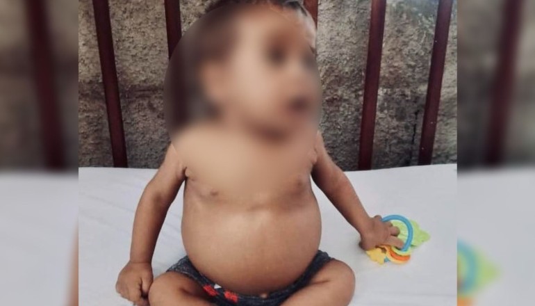 Bebé cubano que necesita trasplante de hígado
