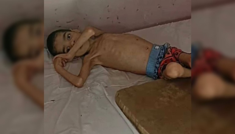 Niño cubano con desnutrición severa