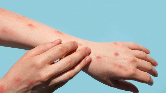 Monkeypox | Marina Demidiuk Monkeypox | Marina Demidiuk