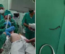 Operación de niño que se tragó un clavo en Holguín