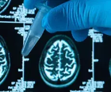 La Inteligencia Artificial ya puede predecir si padecerás Alzheimer