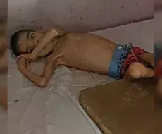 Niño cubano con desnutrición severa