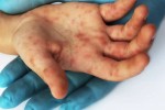 Lesiones en la piel causadas por la viruela del mono